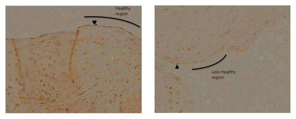 Varicose vein에 peroxidasin에 대한 면역조직화학염색 Arrow head는 peroxidasin이 발현되는 endothelium을 나타낸다. endothelium의 intact하여 heatlhy한 region에서는 peroxidasin의 발현이 강하지만 intact하지 못해 healthy해 보이지 않는 region에서는 peroxidsain의 발현이 약하다