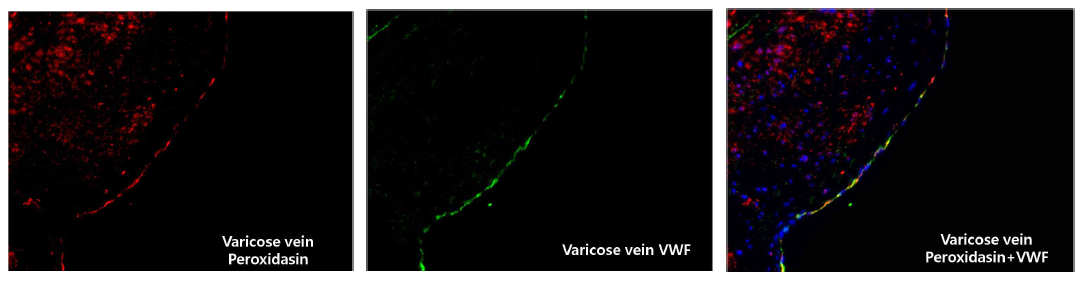 Varicose vein에 peroxidasin과 vWF에 대한 면역조직화학염색