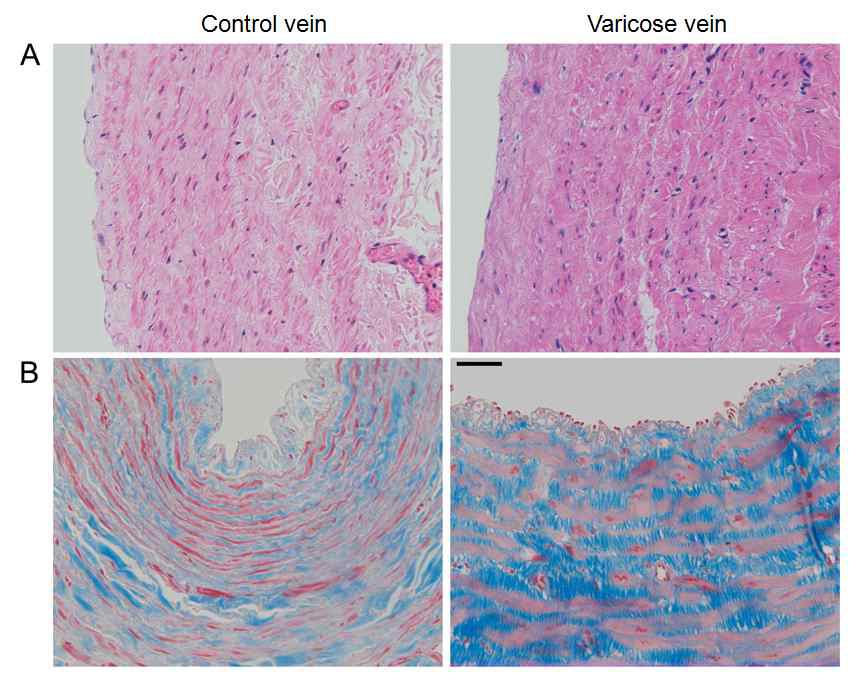 Varicose vein과 control vein의 비교 A: Hematoxylin and Eosin (H&E) stain B: Masson’s trichome stain