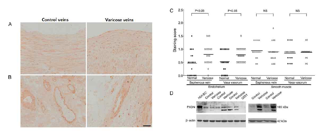 control vein과 varicose vein에서 peorxidasin 발현 양상 조사 A: Saphenous vein에서 peroxidsain 발현의 대표적 양상 B: Vasa vasorum에서 peroxidasin 발현의 대표적 양상