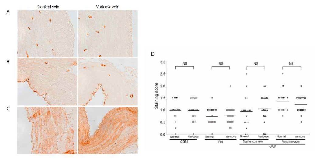 control vein과 varicose vein에서 endothelial marker & fibrocentin 발현 조사 A: Endothelial marker CD31 발현의 대표적 양상 B: Endothelial marker vWF 발현의 대표적 양상 C: Fibronectin 발현의 대표적 양상 D: 여러 환자 유래 varicose vein의 Endothelial marker & fibrocentin 발현 패턴 양상