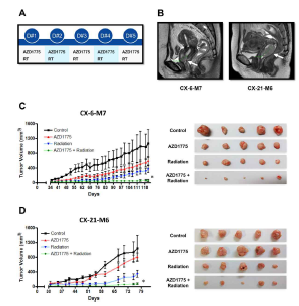 Combination effect of AZD1775 and IR in cervical cancer PDX models