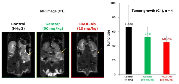 췌장암환자유래 종양 동소 이종 이식 모델에서 PBP1510의 종양 성장 억제 효능 (Case 1)