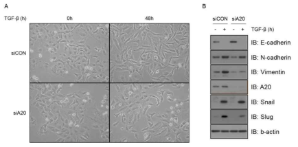 A20-knockdown A549 폐암 세포주에서 TGF-β 매개 EMT 현상 분석