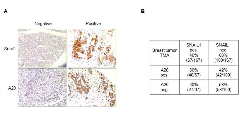국내 유방암 환자 TMA 샘플에서 IHC를 통한 A20, Snail1 단백질의 발현 연관성 분석