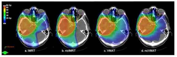 첨단 방사선치료기법의 환자 체내 방사선량 분포 예시, 뇌에 위치한 종양에 처방 방사선량을 전달하는 동시에 정상 장기의 피폭을 최소화