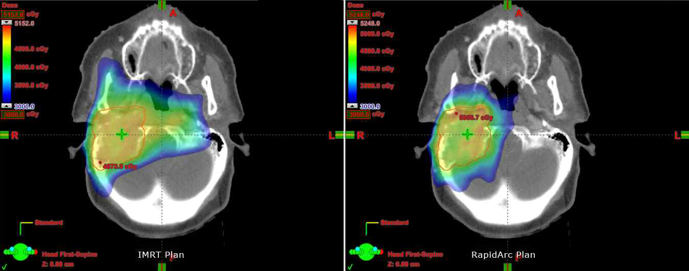 첨단 방사선치료는 방사선량 분포가 암 조직 주변에서 급격히 감소함, 따라서 방사선량 전달에 오차가 있을 경우, 주변 정상 조직은 높은 방사선에 피폭됨