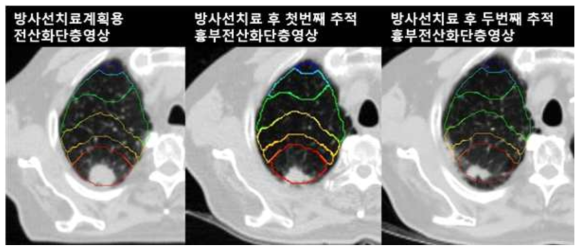 해부학적으로 치료계획용 전산화단층영상에 맞춰 변형돼 등록된 영상들. 폐 안의 실선은(진한파랑, 6-12 Gy; 청록색, 12-18 Gy; 초록, 18-24 Gy; 노랑, 24-36 Gy; 주황, 36-48 Gy; 빨강, >48 Gy) 방사선량별 분포