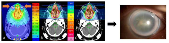 두경부 방사선치료의 예, 수정체에 전달되는 방사선량을 최소화하도록 치료계획 수립했지만 실제 수정체에 전달된 방사선량 평가는 어려, 오른쪽 그림은 방사선치료 부작용으로 환자에게 백내장이 발병한 경우