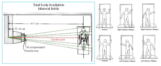 전신방사선조사(좌) 및 전신 전자선 조사(우)