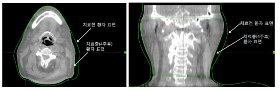 방사선치료를 받는 두경부암 환자의 치료 전(좌) 및 치료 중(우) 몸무게 변화에 따른 부피 변화