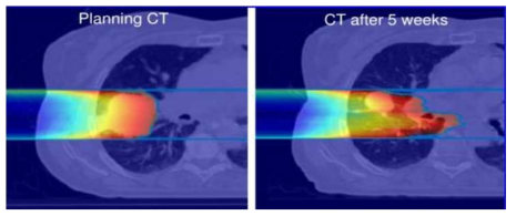 첨단 방사선치료 시, 환자 체형 변화 및 종양 크기 감소로 인한 방사선량 전달의 변화, 5 주 후에 종양에는 처방선량이 전달되지 않고 정상조직에 높은 방사선량이 피폭됨을 확인할 수 있음