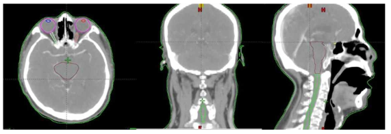 환자 CT에 정의된 정상장기 윤곽정보(안구, 수정체, 시신경, 뇌간, 척수가 정의되어 있음)