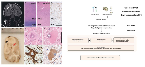 Research flow to identify genetic causes of focal cortical dysplasia