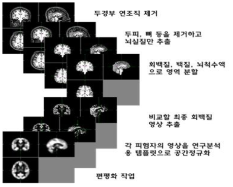 T1 images 분석: 각 voxel level에서 gray matter volume 측정