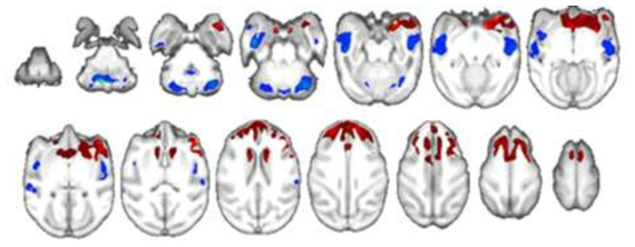 MPTP를 이용한 파킨슨 병 영장류모델에서 T1-weighted images를 분석한 결과 특정 뇌영역(insula, temporal gyrus, cerebellum)의 회백질 부피가 감소 (Manuscript under review at Radiology)