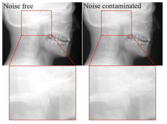 잡음 포함 여부에 따른 X-선 영상