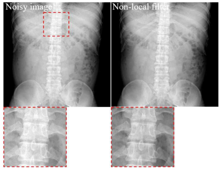 Chest-abdomen 촬영 X-ray 영상: noisy 및 non-local filter 적용 영상