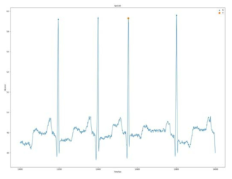 이상 상태를 담고 있는 ECG signal