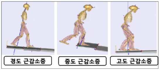 근감소증 진행 정도에 따른 환자 맞춤형 근골격계 컴퓨터 모델