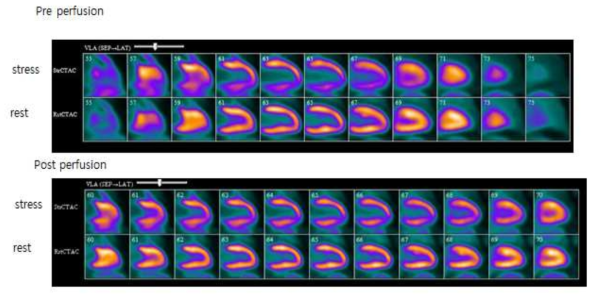 ammonia PET 검사, 상: perfusion 전/ 하: perfusion 후