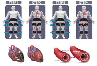 EECP 작동 원리와 심혈관계 효과
