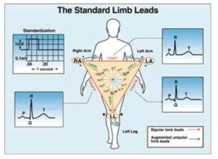 표준 심전도 Lead