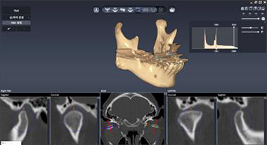하악턱관절 분할 및 TMJ 운동 축 설정 도구 개발