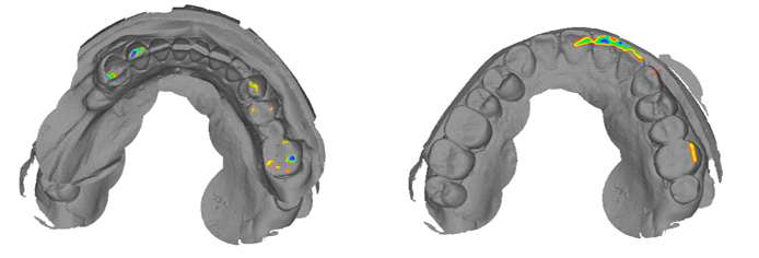 하악턱관절 움직임에 따른 실시간 상/하악 치아교합 분석 알고리즘 개발