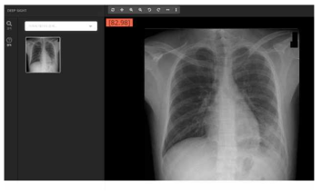 흉부 X-Ray 진단 화면