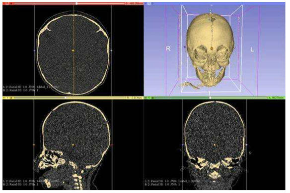 3DSlicer에서 3D 모델링 두개골 확인