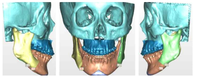 환자 CT 결과를 기반으로 시행한 3D 가상수술