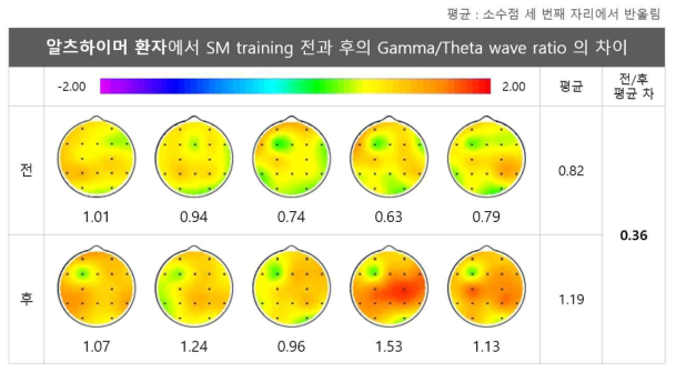 알츠하이머성 치매 환자에서 인지재활훈련(soundmind training) 전과 후의 Gamma/Theta wave ratio 차이: 색이 붉을수록 Gamma/Theta wave ratio가 크다는 것을 의미하고, 즉, 인지능력이 향상하였다는 것을 나타냄