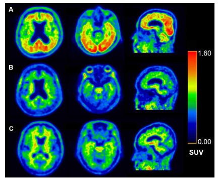 (A) 알츠하이머 치매환자 (B) 비알츠하이머 치매환자 (C) 정상인의 [18F]FC119S PET