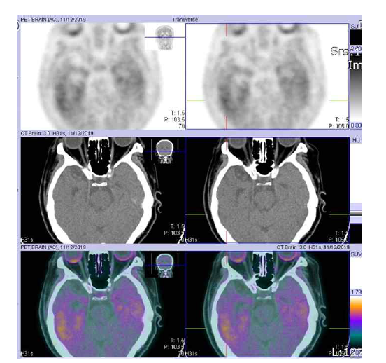 한국원자력의학원에서 촬영한 18F-AV-1451 PET 영상. 76세 여성, 혈관성 치매환자