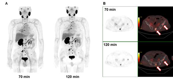 전립선암 환자에서 [18F]Florastamin 주사후 시간에 따른 섭취 변화를 보여주는 PET 영상