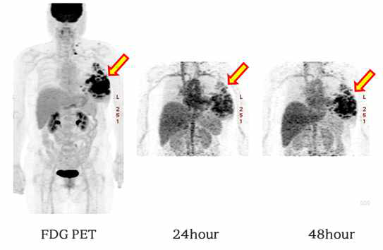 유방암의 64Cu-DOTA-trastuzumab PET 영상