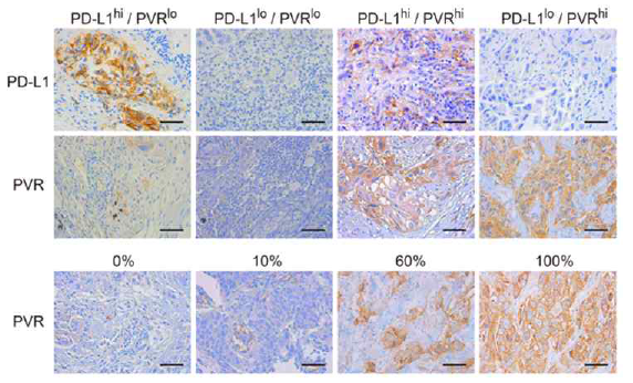 비소세포폐암 암조직에서 PD-L1 및 PVR 염색 대표사진