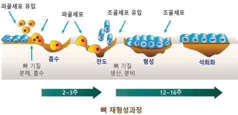 뼈 재형성과정