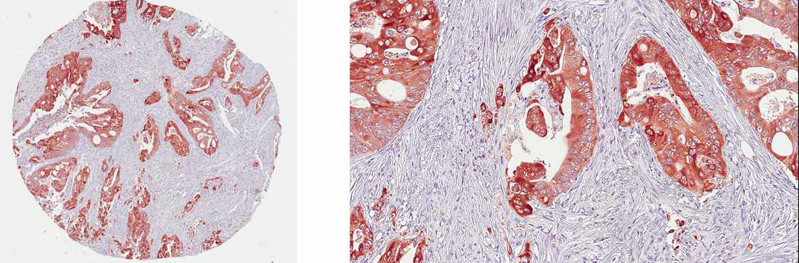EZR의 대장암 환자의 조직면역화학염색 결과 (대표 1례)