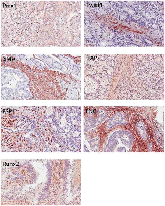 대장암 환자 조직(CAF)의 IHC 염색 결과(대표 1례)