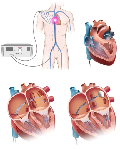 카테터를 사용한 부정맥치료 개념도 (좌) 부정맥치료용전극카테터, (우) 부정맥치료용풍선카테터