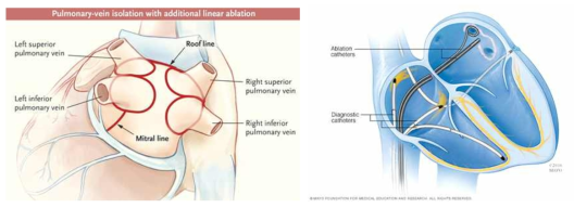 좌 : 부정맥 중재시술치료를 위한 폐정맥차단술 카테터의 소작경로(빨간색), 우 : 폐정맥 차단술용 카테터