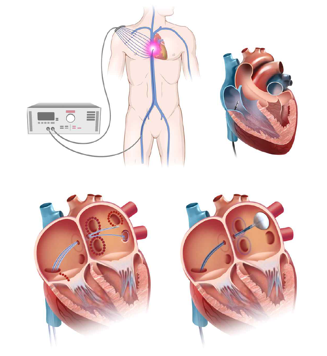 카테터를 사용한 부정맥치료 개념도 (좌) 부정맥치료용전극카테터, (우) 부정맥치료용풍선카테터