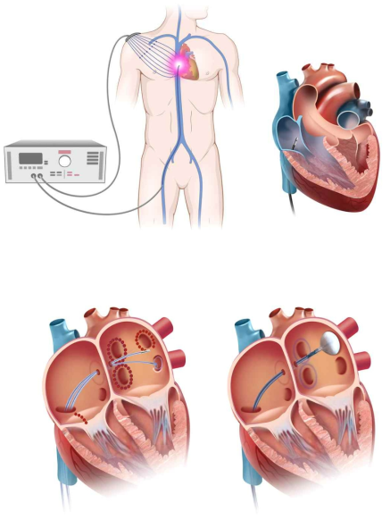 카테터를 사용한 부정맥치료 개념도 (좌) 부정맥치료용전극카테터, (우) 부정맥치료용풍선카테터
