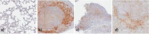 a)정상 폐조직, b) NCI-H460 세포 유래 폐암 조직, c) 전이된 폐암 조직, d) 전이된 뼈 조직의 CD55 항체의 조직면역염색 결과