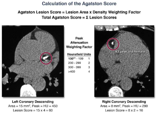 각 병변의 석회화 정도를 나타내는 Agatston score는 CAC area와 maximal CAC density의 상관관계로 나타낼 수 있다. Total Agatston score는 간단하게 모든 CAC 병변의 합을 나타내며, calcified lesion은 contiguous voxels이 130 HU 보다 클 때를 의미한다