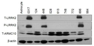 뇌종양 환자 세포주에서 LRRK2 발현 분석