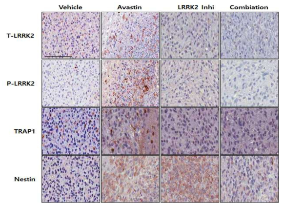 뇌종양 줄기세포를 이용한 LRRK2 저해제와 Avastin과의 병용실험에서 LRRK2/pLRRK2와 미토콘드리아 기능관련 TRAP1, 줄기능 관련 Nestin 발현확인 결과