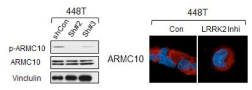 뇌종양 환자 세포주에서 LRRK2의 발현과 ARMC10과의 발현양상 비교